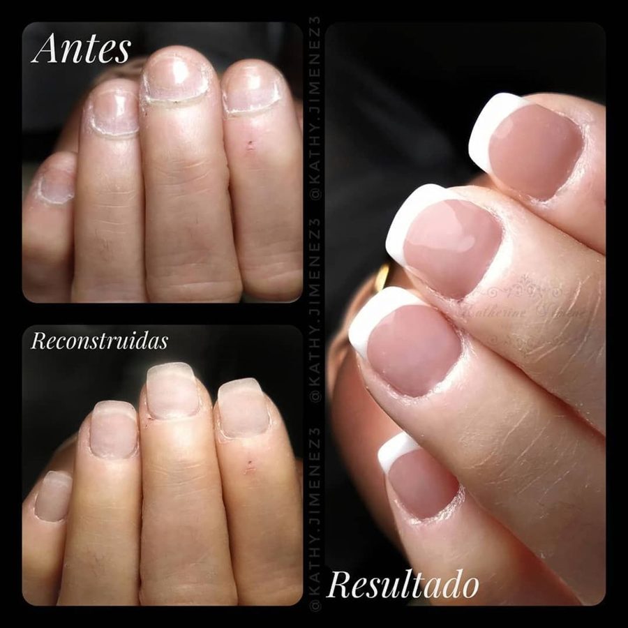 Antes y después de una reconstrucción de uñas mordidas en Xirivella
